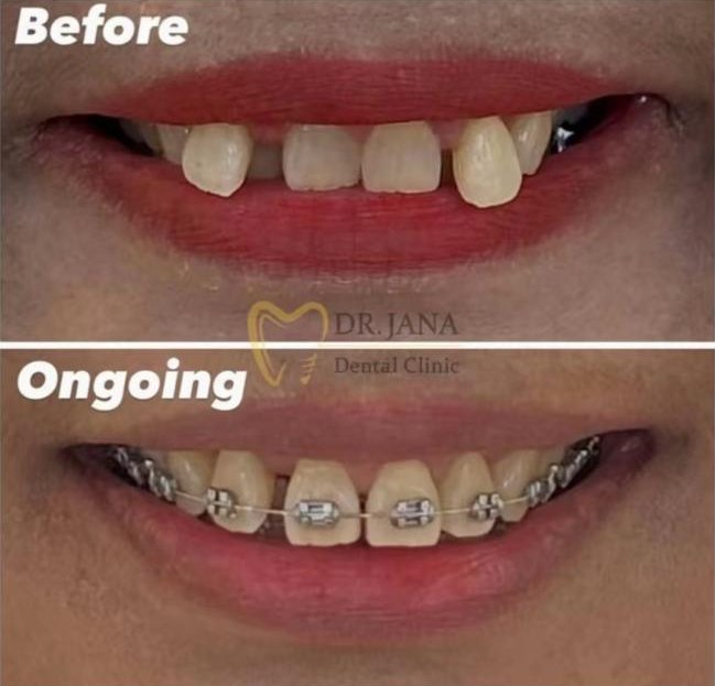 Braces patient before treatment and during treatment