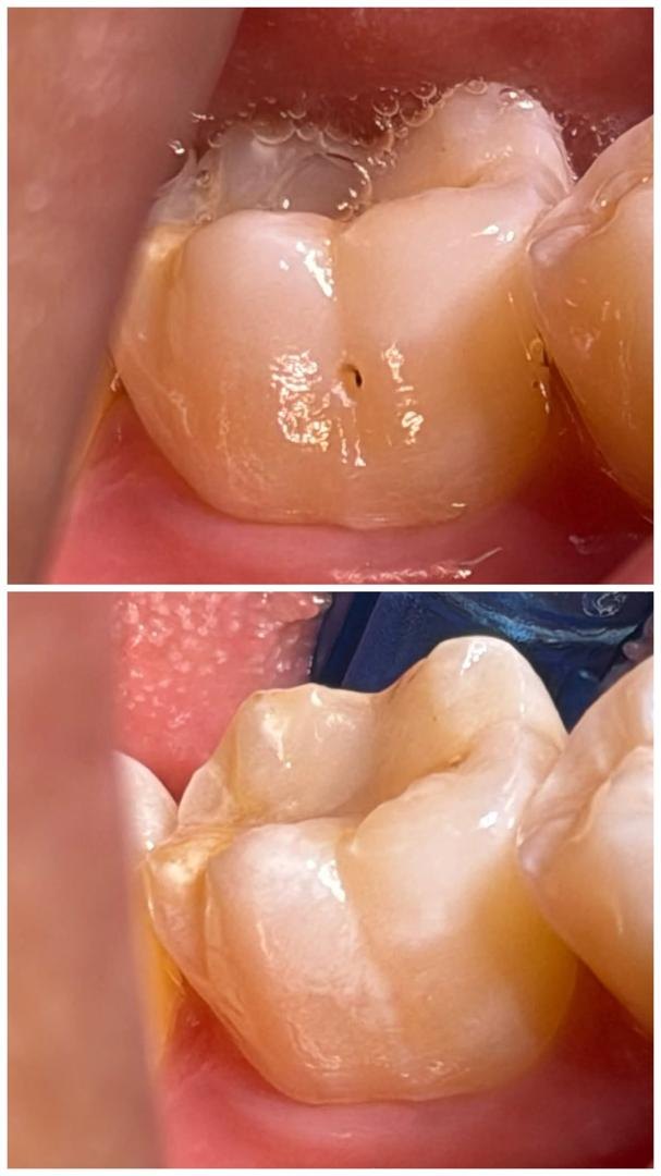 Back tooth groove before and after fissure sealant