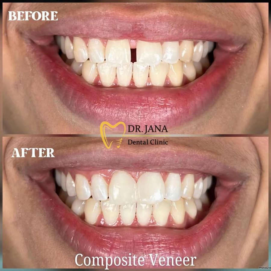 Composite veneer before and after, patient 1