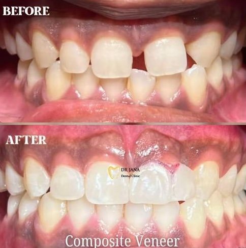 Composite veneer before and after, patient 2