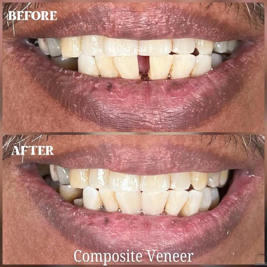 Composite veneer before and after, patient 3