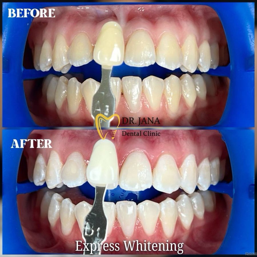 Express Whitening before and after, patient 1