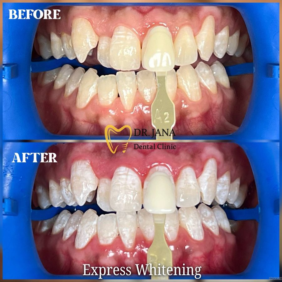 Express Whitening before and after, patient 2