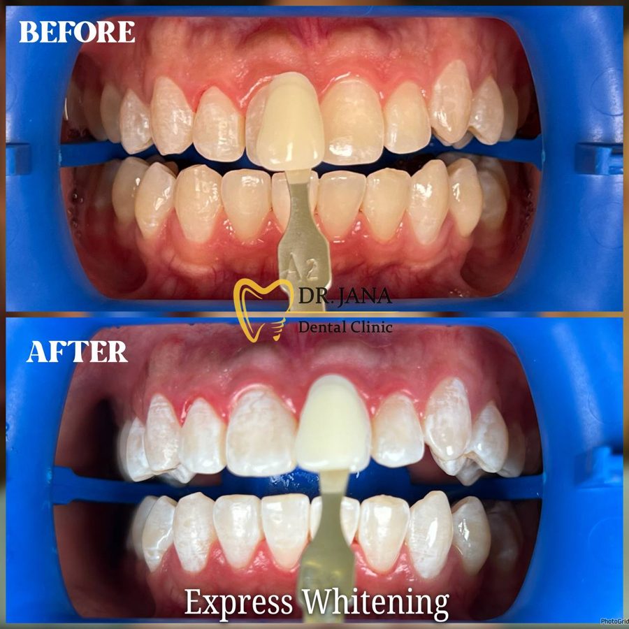 Express Whitening before and after, patient 3