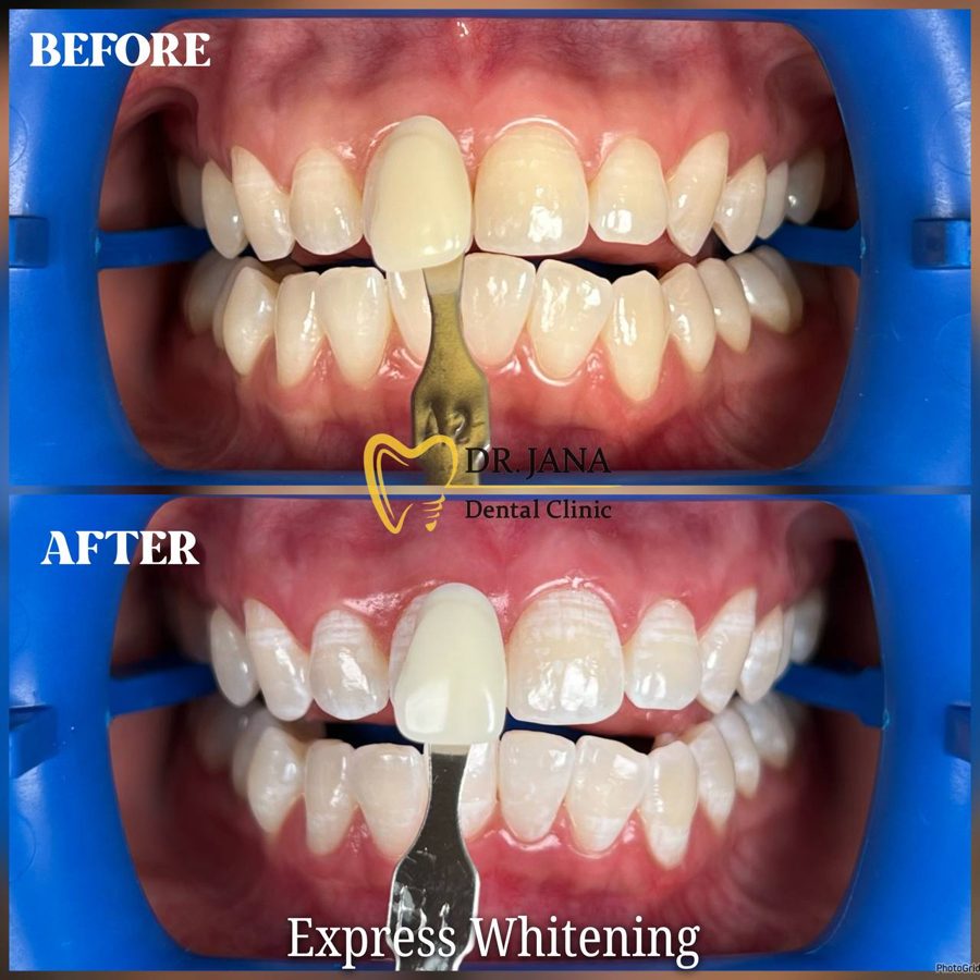Express Whitening before and after, patient 4