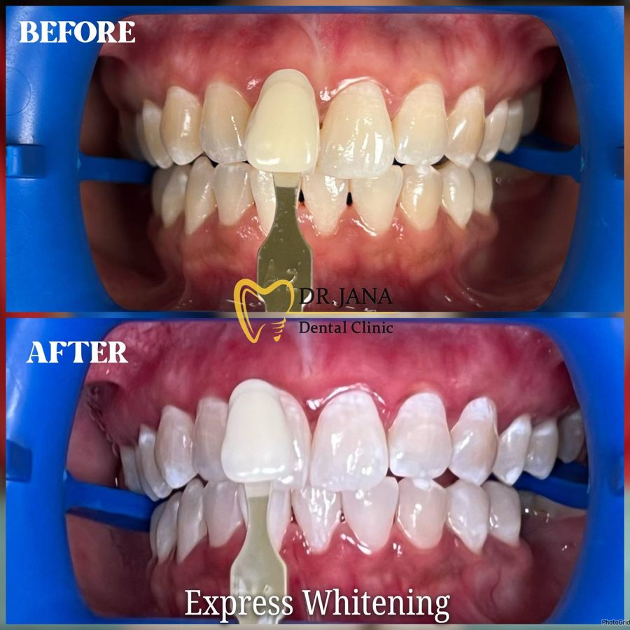 Express Whitening before and after, patient 5